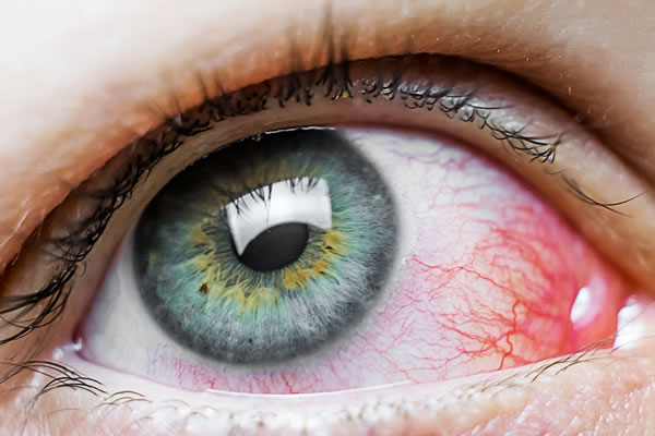 Ospaca | Campañas de Prevención - Conjuntivitis