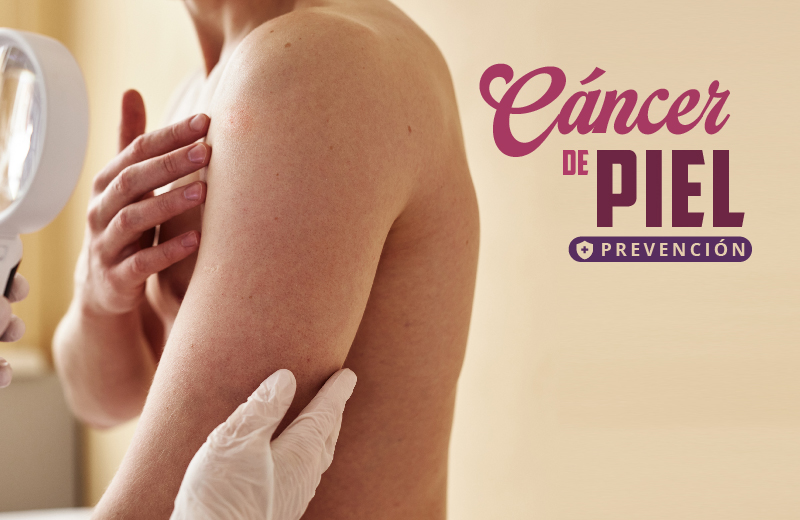 CÁNCER DE PIEL